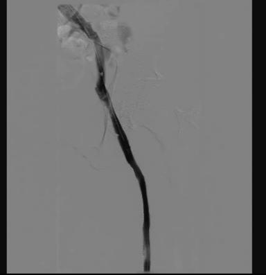 Figure 5. Final venogram revealing excellent angiographic result with brisk flow through the entire stented segment with excellent stent apposition under intravascular ultrasound imaging.