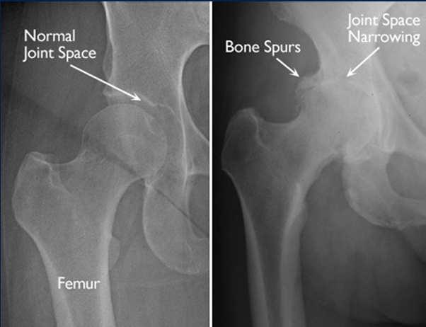 Radiographic Findings Treatment AP Pelvis Joint space narrowing Subchondral sclerosis Osteophytes Conservative Physical Therapy Gluteal and core strengthening Cortisone