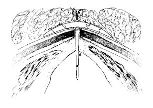 The keel also has application following hemilaryngectomy to prevent stenosis. The intralaryngeal extension of the keel is thinner than the umbrella of the extralaryngeal portion.