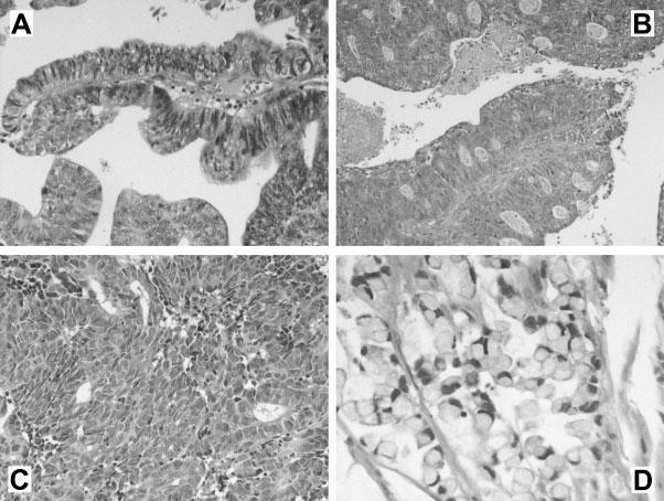 FIGURE 1. Photomicrographs of the 4 histopathological types of intestinal-type sinonasal adenocarcinomas (ITAC) studied in this article. Papillary type or PTCC-I.