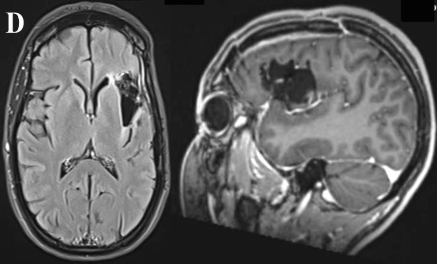 Awake Brain Mapping Case 1 Pathology IDH1+, 1p19q- Immediate postop hesitancy with speech, dysarthria 2 weeks postop
