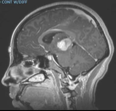 sensory cortex Subcortical: SLF/AF, IFOF, thalamus, basal