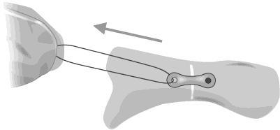 5. Apply traction or compression force proximally with help of suture to close gap between