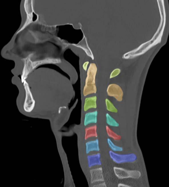 CERVICAL VERTEBRAE Articulation allows head movement C1 - atlas C2 axis Protects vital neural and vascular