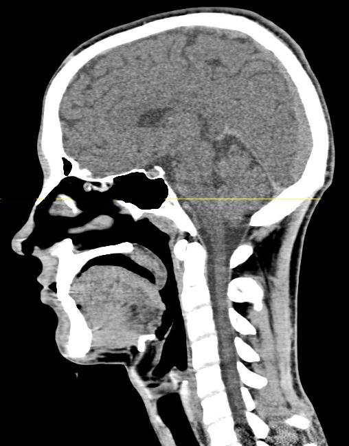 BRAIN PARENCHYMA Basic anatomy Cerebral hemispheres divided by falx