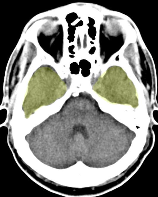 BRAIN PARENCHYMA Basic anatomy Cerebral hemispheres divided by falx cerebri