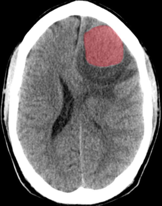 CASE: INTRACRANIAL ABNORMALITY Axial What is the cause of the mass effect? A. Trauma B.