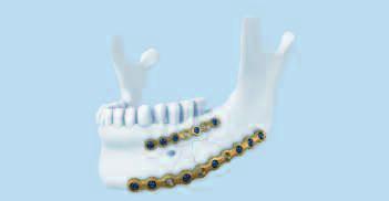 Indications and Contraindications Indications Mandible trauma Orthognathic surgery Reconstructive surgery with microvascular bone grafts Plate thickness Plate type Primary