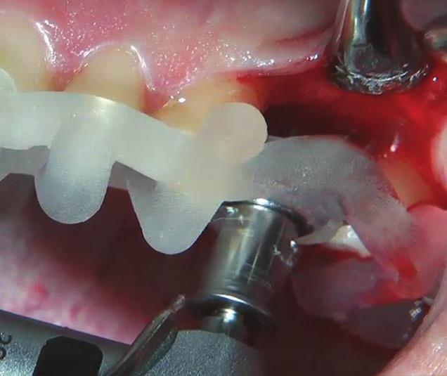 Restorations and immediate provisional prosthetic solutions.
