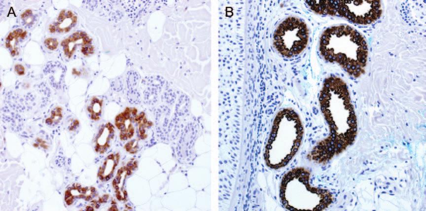 CD23 expression in non-lymphoid neoplasms Fig. 1. The expression of CD23 in normal skin appendages. CD23 intensely labels the luminal cells of eccrine (A) and apocrine (B) secretory coils.