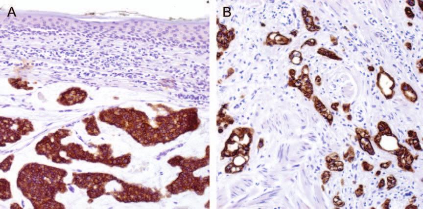 As MAC is a heterogeneous group of adnexal neoplasm, a variable pattern of staining was observed. As previously reported for CD5, 16 CD23 also only labeled the glandular elements.