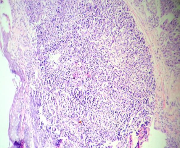 tumour arranged in nest and comprised of basaloid cells exhibiting peripheral palisading embedded in fibrous stroma. Jayalakshmi and Looi [3] reported 29.