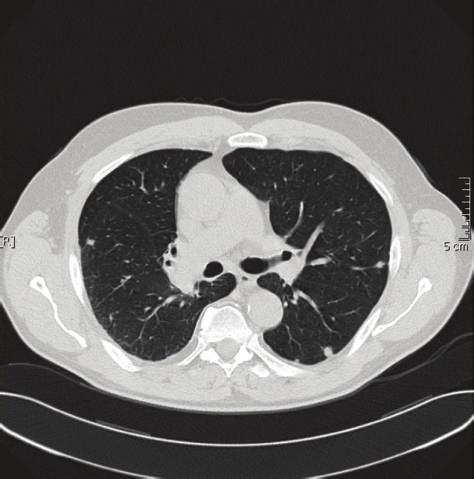 Case Reports in Oncological Medicine 3 Figure 3: CT scan before the palliative chemotherapy with docetaxel and gemcitabine ; the reevaluation CT scan showed clear bilateral pulmonary progression