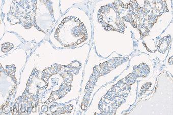 Fig 3b Insufficient staining for CK9 of the papillary thyroid carcinoma using same protocol as in Figs. b & 2b.
