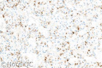 Fig 4a Optimal staining for CK9 of the pancreatic neuroendocrine carcinoma using same protocol as in Figs. a - 3a.