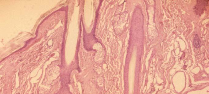 Papillary dermis: numerous cells Fibroblasts loose collagen type III: reticular