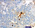 cholagioca Mesothelioma Ovarian Cancer PAC Prostate % Change from baseline macrophage area coverage Carlos Alberto Gomez-Roca, MD Phase I study of RG7155, a novel anti-csf1r antibody, in
