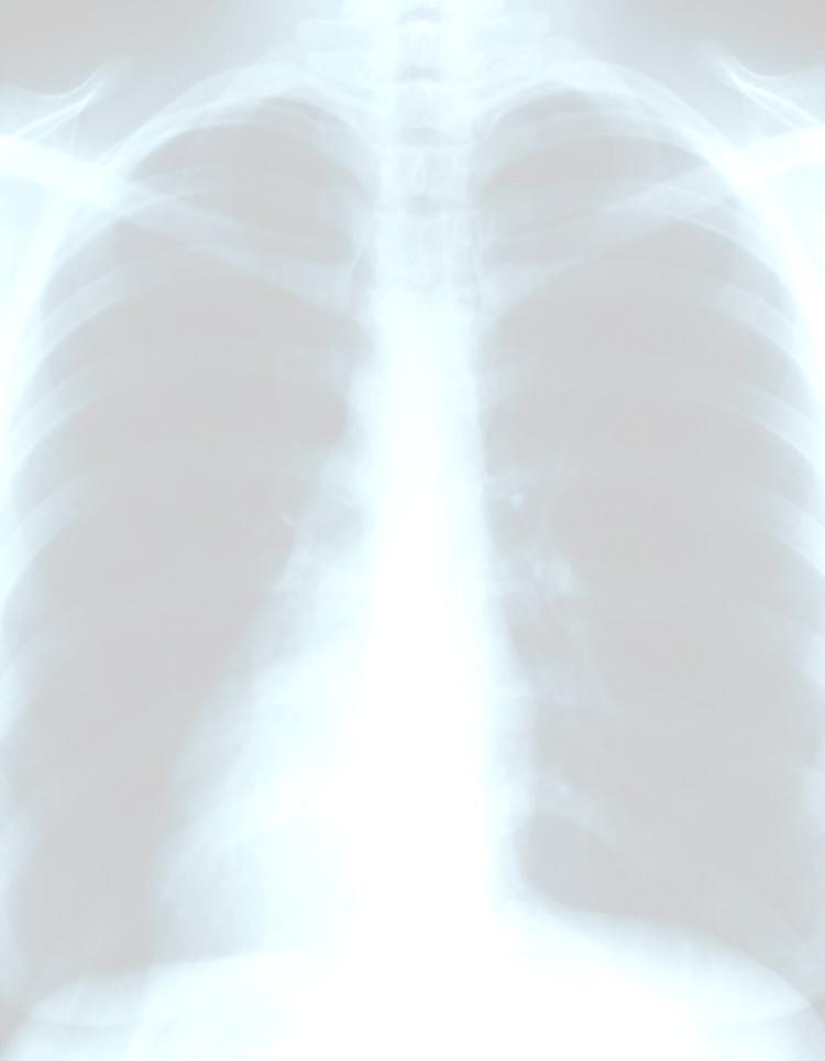 The successful implementation of a single PBP in respiratory care may not result in a decrease in the BPD rate Vent days