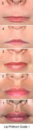 The palpebral fissures must be two or more standard deviations below the norm and the thin upper lip and smooth philtrum must be a Rank 4 or 5 on the Lip-Philtrum Guide.