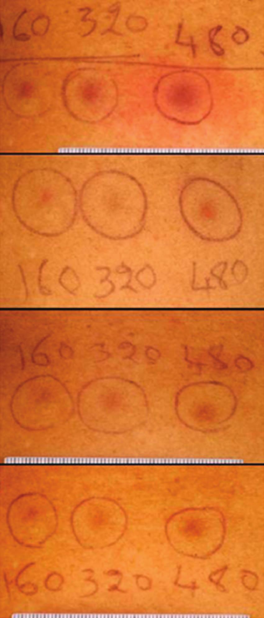 Crosspolarized images of sites irradiated with UVA1 (a d) and visible light (e l) at different times on both type V (e h) and type II (i l) skin.