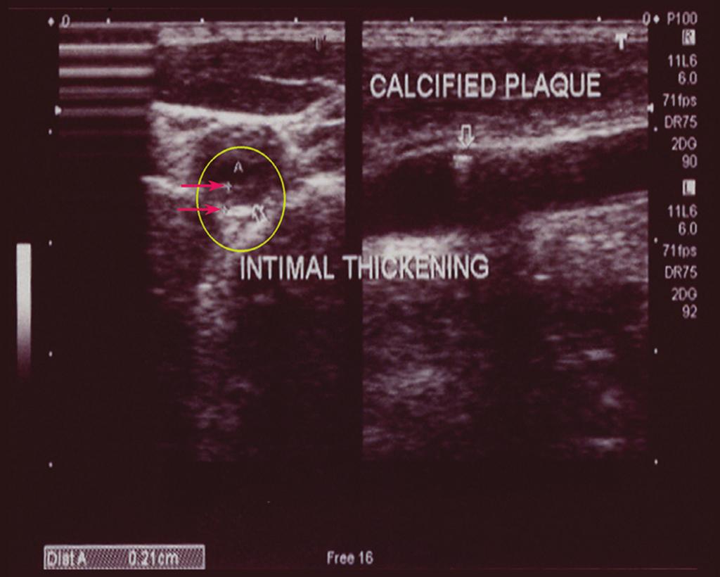 IMT of the common carotid arteries was estimated bilaterally using B-mode ultrasound (Figures 1 and 2).