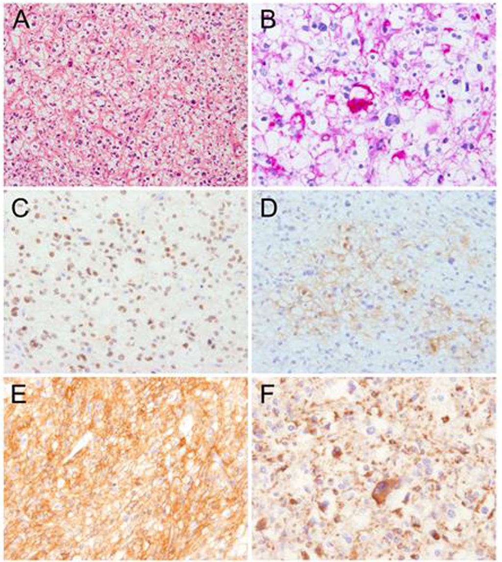 Gunji-Niitsu et al. BMC Medical Genetics (2016) 17:85 Page 5 of 8 Fig. 3 Pathologic findings of a pulmonary nodule in the left lower lobe.