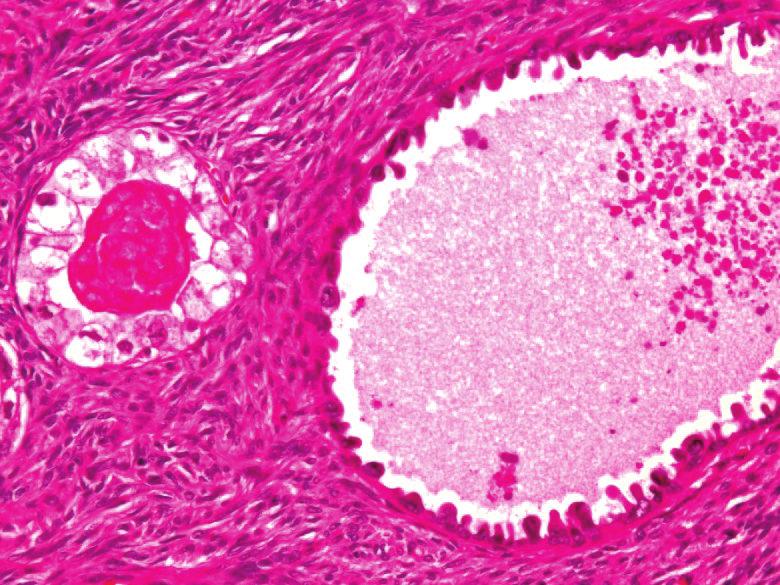 (e) The nodular colonic lesion was composed of dilated endometrioid glands. (f) Focal atypical glands with some papillary structure and nuclei.