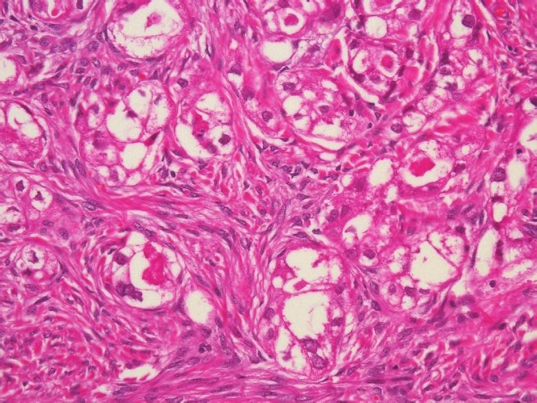 In a previous case report, Wani and Notohara [8] concluded that an identified ovarian clear cell carcinoma had arisen from a mucinous cystadenoma because this case exhibited