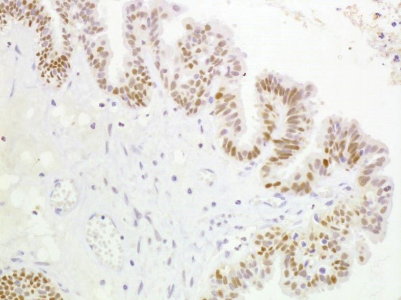4 Case Reports in Obstetrics and Gynecology (a) (b) (c) (d) (e) (f) Figure 3: Immunohistochemical study for (a, b) seromucinous tumor, (c, d) clear cell carcinoma, and (e, f) polypoid