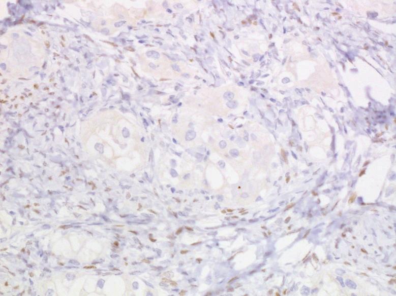 [13] described Napsin A as a useful marker for diagnosis of ovarian clear cell adenocarcinoma.