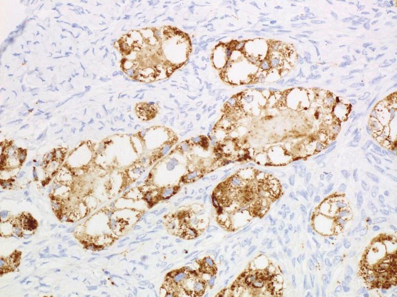 Therefore, the findings of our case support that Napsin A is a sensitive and specific marker of clear cell carcinoma in ovaries.