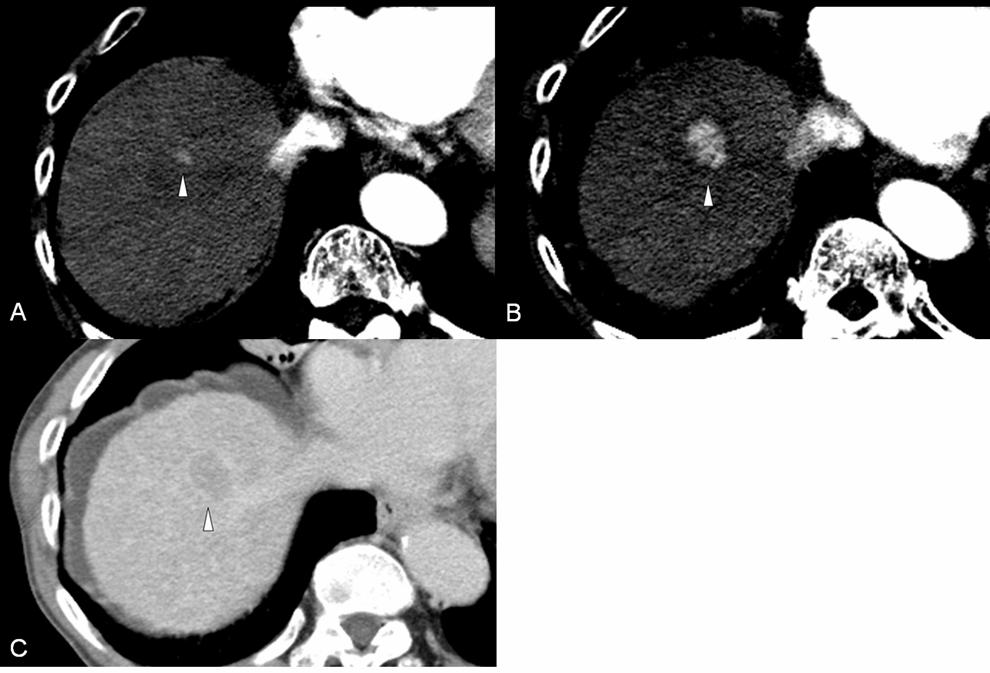 Fig 1. A 71-year-old man with a hepatocellular carcinoma that increased in size during a 12-month follow-up.