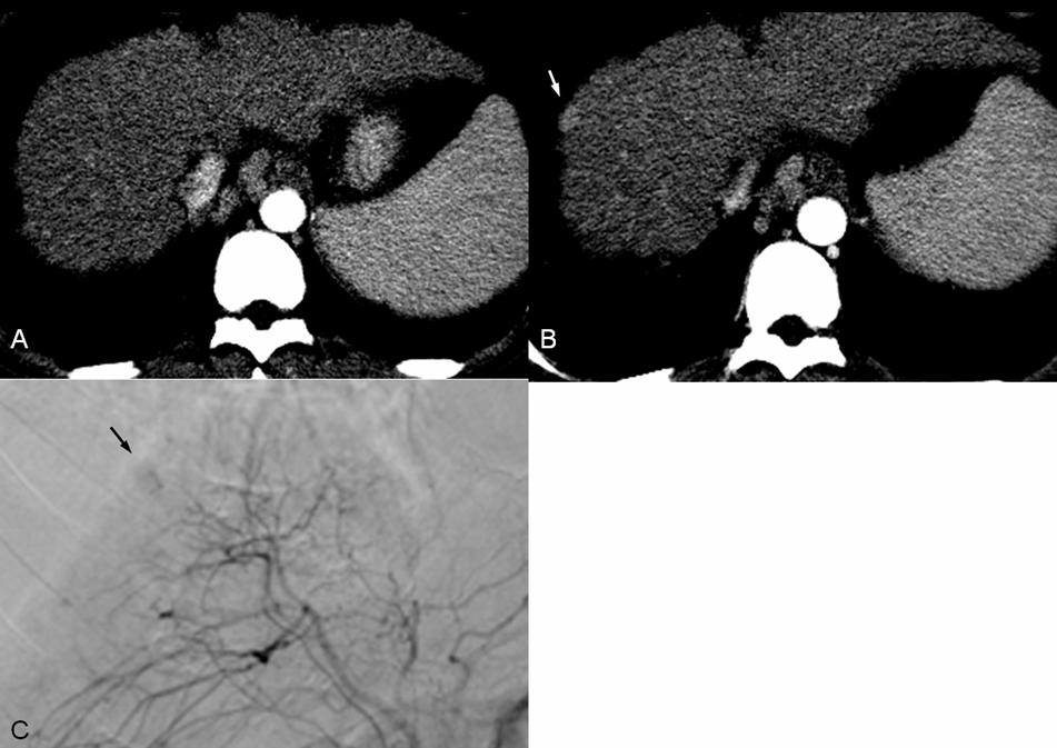 Fig 3. A 40-year-old man with a non-tumorous arterioportal shunt verified angiographically.