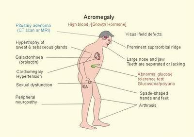 Acromegaly-