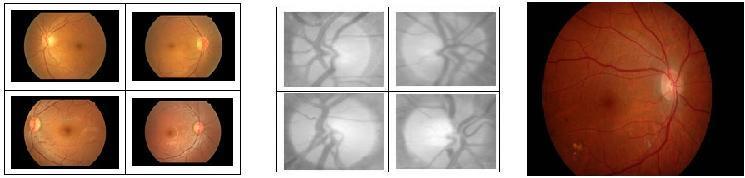 (h) Adjusted Image (i) Extracted Blood Vessel Image ii. Detection of Exudates Exudates have different shapes, sized and usually bright or yellow in color.