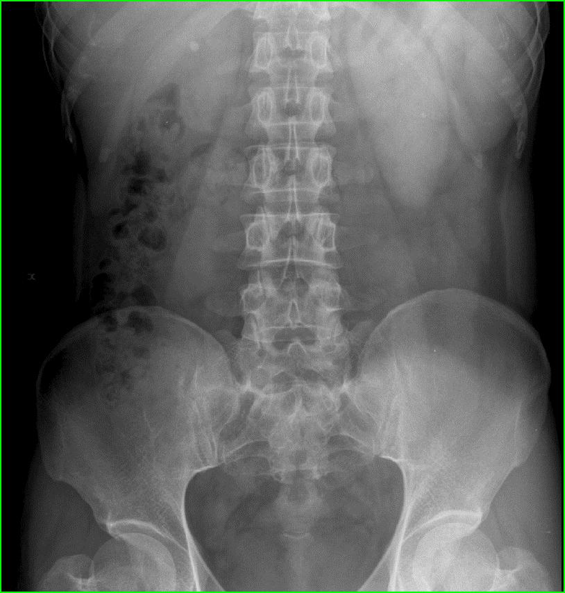 1 X-ray Exam Fluoroscopy Radiography (plain film) The X-ray examination has very limited