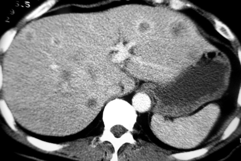 Metastatic Liver Carcinoma CT