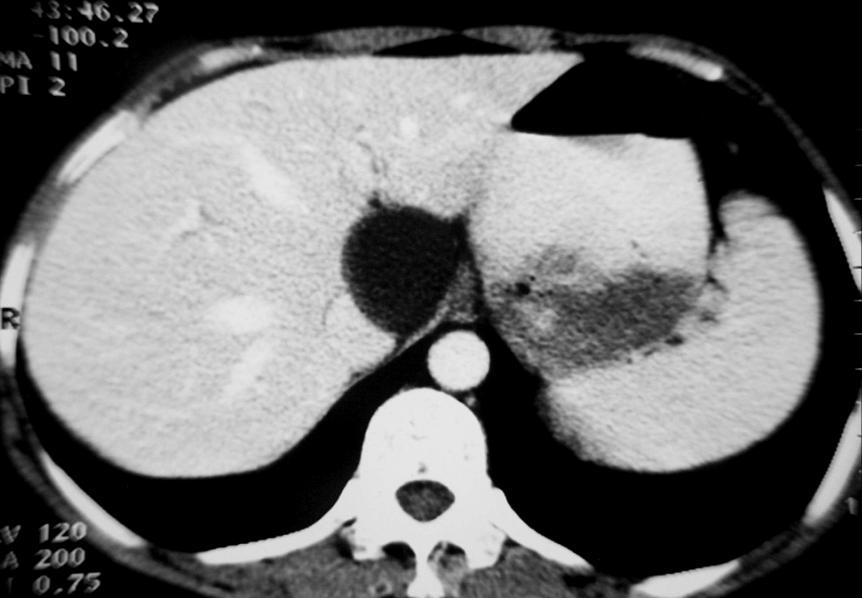 3 Liver Cyst CT appearance: The