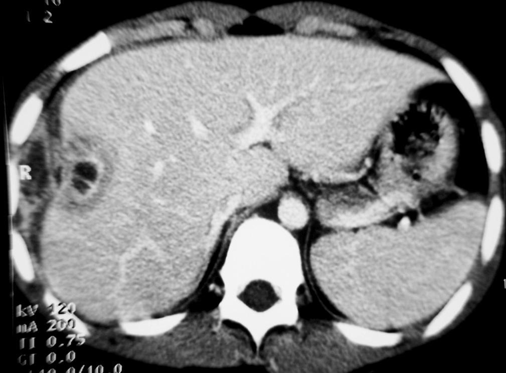 4 Liver Abscess CT appearance: The