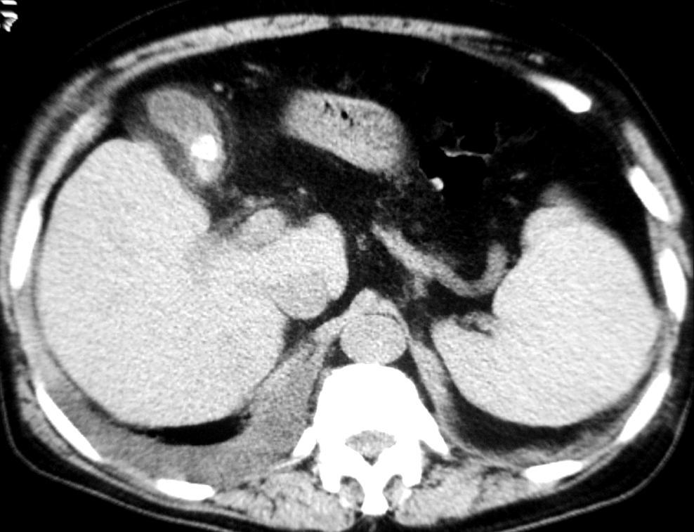 Cholecystitis with