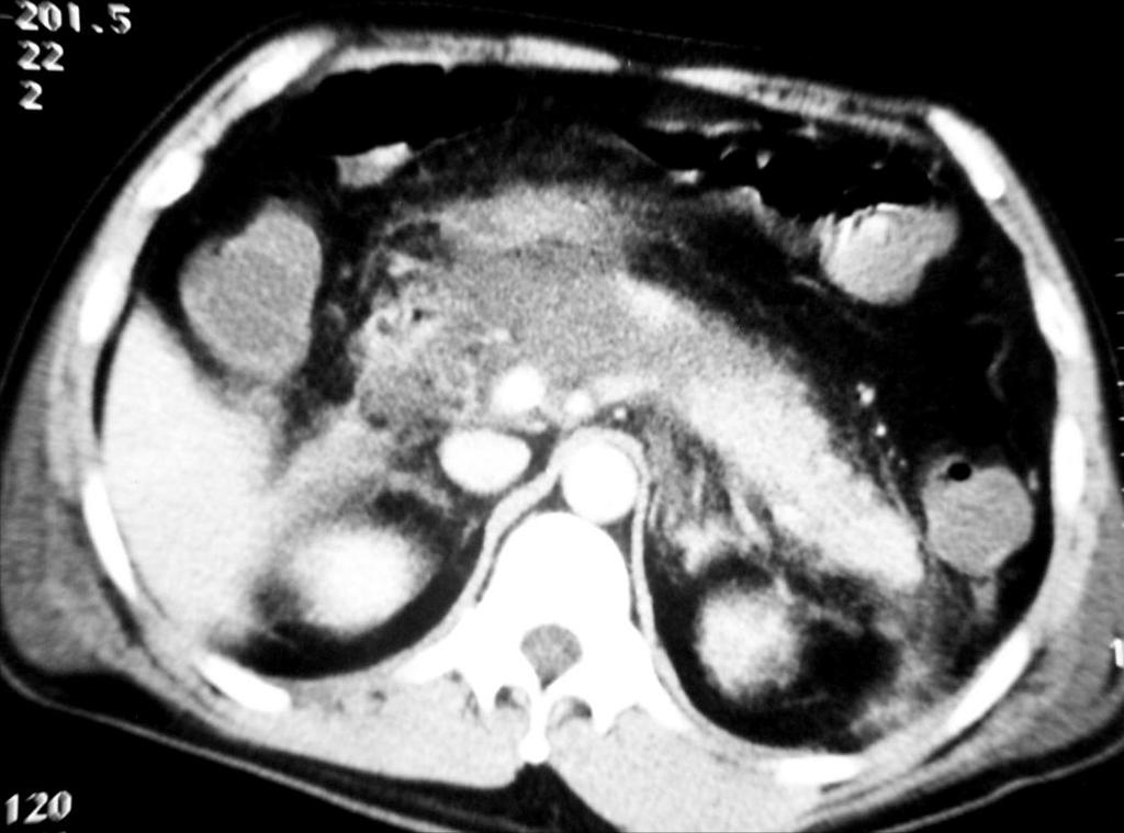 1 Acute Pancreatitis CT appearance: AP appears as pancreatic edema