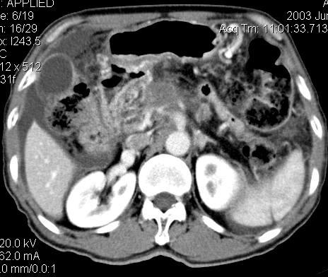 3 Pancreatic Carcinoma CT