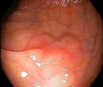 Weaknesses of ADR ADR and serrated lesions" Sessile Serrated Adenoma/polyp technically not part of ADR measurement.
