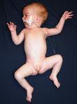 What is a floppy baby? Elbows and knees loosely extended. Head control is usually poor or absent.