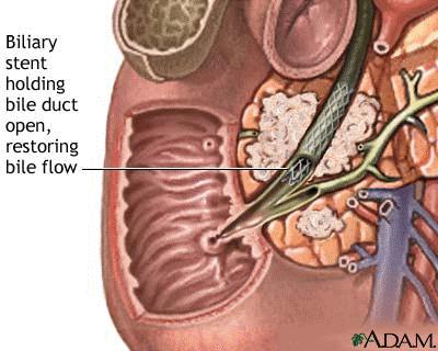 a wire is inserted through the catheter into the bile duct.