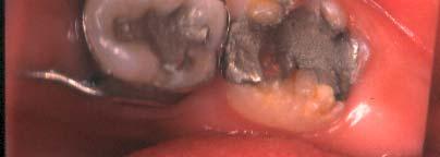 Problems of First Permanent Molars