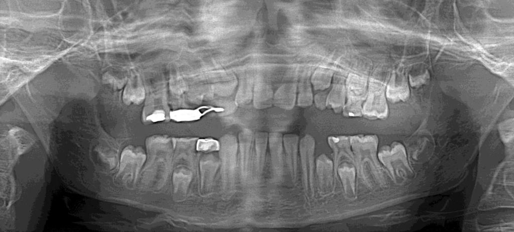 16 54 lost Middle mixed dentition with caries on several teeth All permanent teeth present, not all erupted Minimal crowding Early loss of 54 with space maintainer Mesial drifting 16 localized space