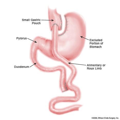 1960 s 1966- First Gastric Bypass surgery Combination of food restriction and malabsorption Associated with