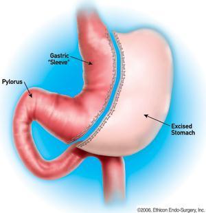 Sleeve Gastrectomy Tubular Stomach