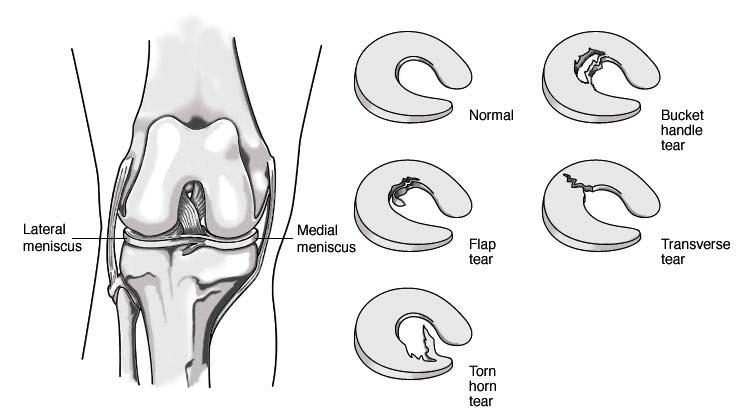 Meniscal Injuries Menisci are shock absorbers within the knee and are composed of two pieces of gristle within the knee joint, one in the inner compartment (medial meniscus) and one in the outer